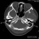 颅骨嗜酸性细胞肉芽肿_360百科