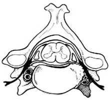 颈椎病前路减压术