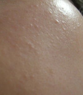 封闭性痘痘_360百科