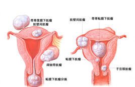 阴道不规则出血