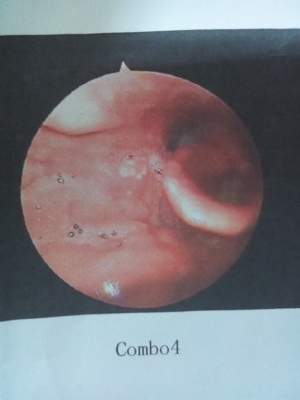 喉咙处有异物感,十来天了,不疼不痒不咳嗽,早上