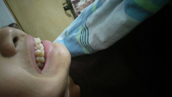 这样的上排牙齿突出是什么症状 在天津治疗大
