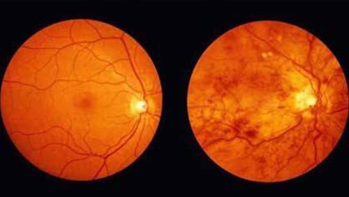 葡萄膜炎_360百科