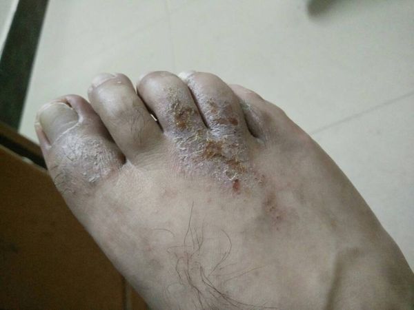 香港脚症状图片